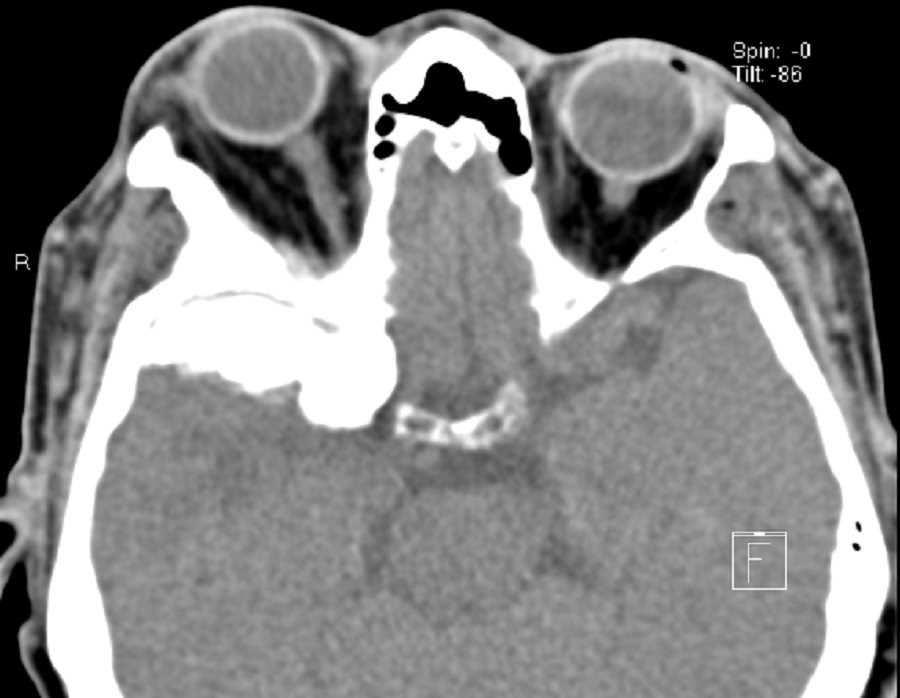 Sphenoid Wing Meningioma - CTisus CT Scan