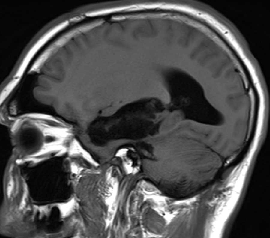 Epidermoid - CTisus CT Scan