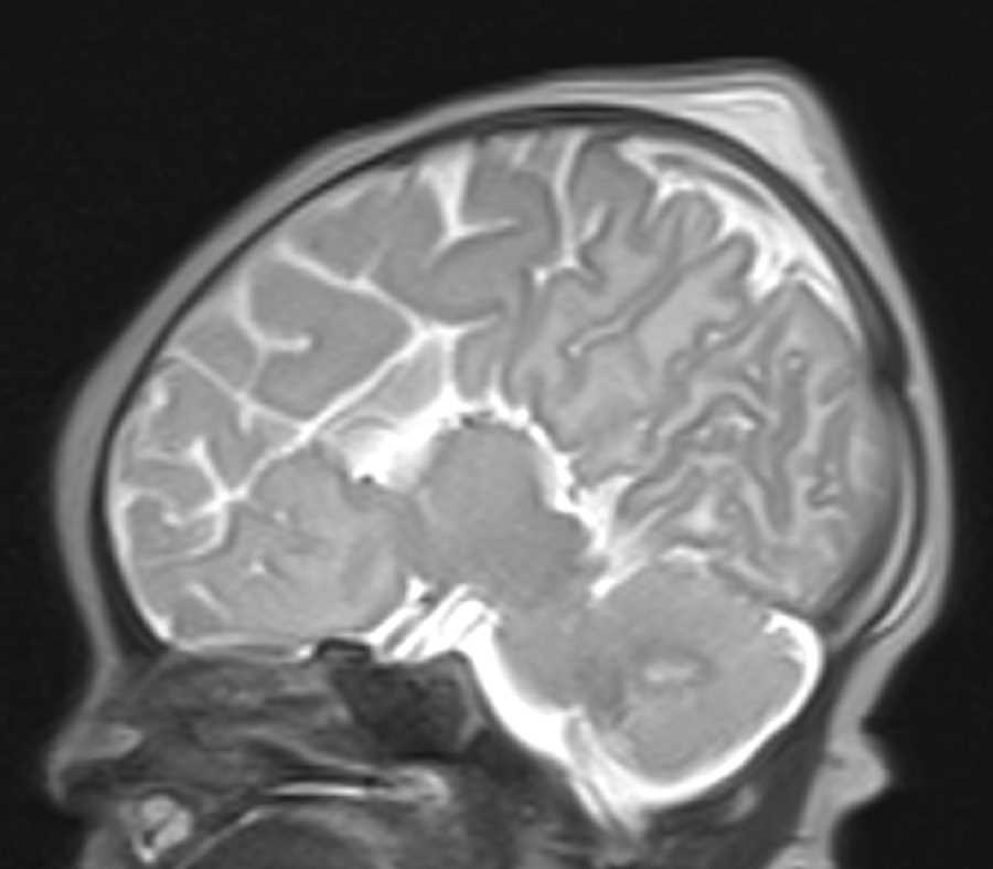 Corpus Callosum Agenesis - CTisus CT Scan