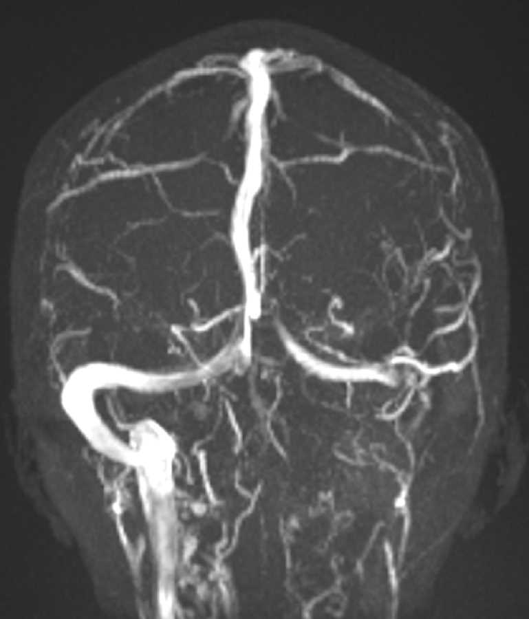 Petrous Apex Abscess - CTisus CT Scan