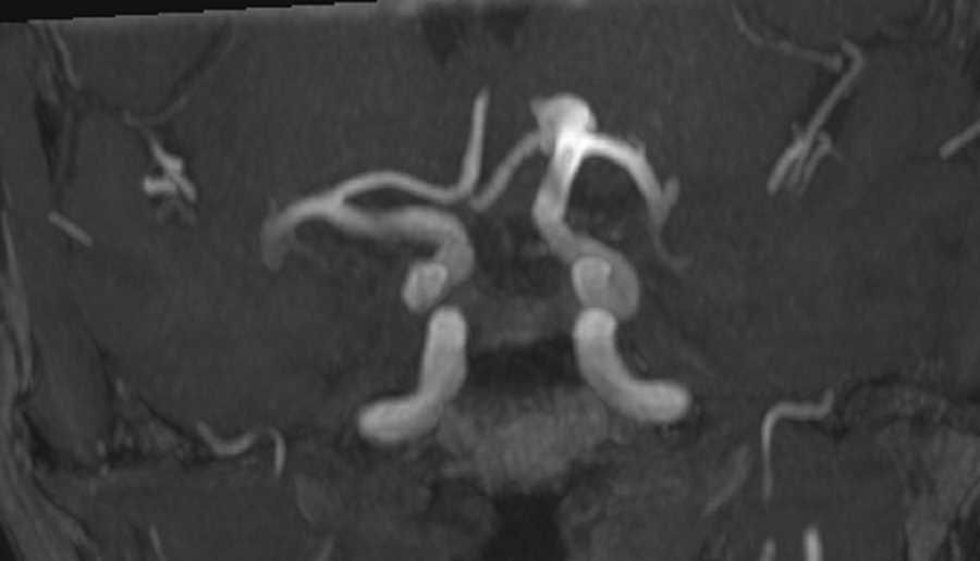 Intracranial Aneurysm - CTisus CT Scan