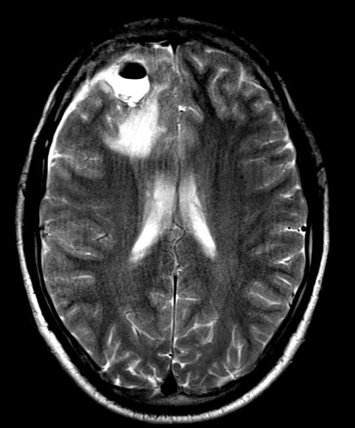 Primary Glioma - CTisus CT Scan