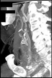 Diseased Carotid Artery Without Stenosis - CTisus CT Scan