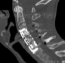 Spinal Fusion - CTisus CT Scan