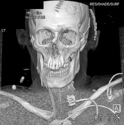 Intubated Patient - CTisus CT Scan