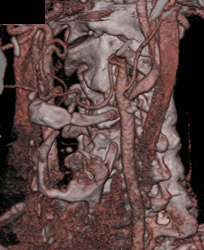 Normal Carotid Artery - CTisus CT Scan