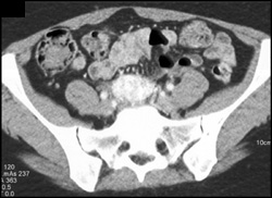 Extra-adrenal Pheochromocytoma in Patient With Carotid Body Tumor - CTisus CT Scan