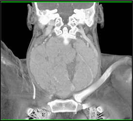 Enlarged Thyroid Gland With Goiter - CTisus CT Scan
