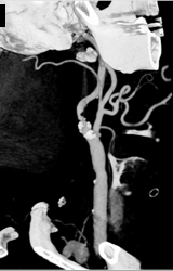 Carotid Artery Stenosis - CTisus CT Scan
