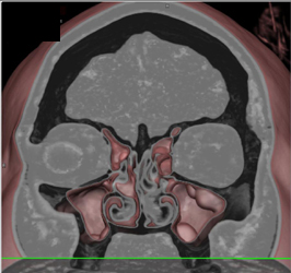 3D of Maxillary Sinus Polyps - CTisus CT Scan