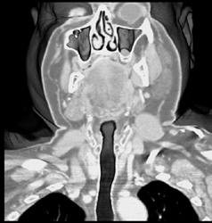Sinus Polyps - CTisus CT Scan