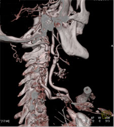 Carotid Stenosis - CTisus CT Scan