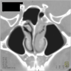 Sinusitis - CTisus CT Scan