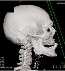 Brain Rock (Osteoma) - CTisus CT Scan
