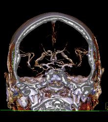 Infarct - CTisus CT Scan