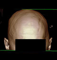 Craniotomy - CTisus CT Scan