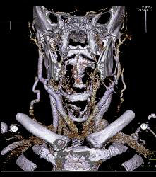 Laryngeal Cancer With Adenopathy - CTisus CT Scan