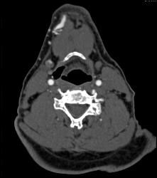 Multiple Views of An Arteriovenous Malformation (AVM) At the Angle of the Mandible - CTisus CT Scan
