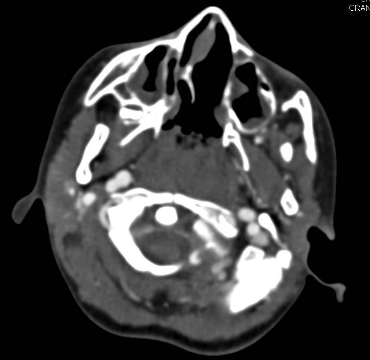 Ectatic Carotid Arteries in Loeys-Dietz Syndrome - CTisus CT Scan