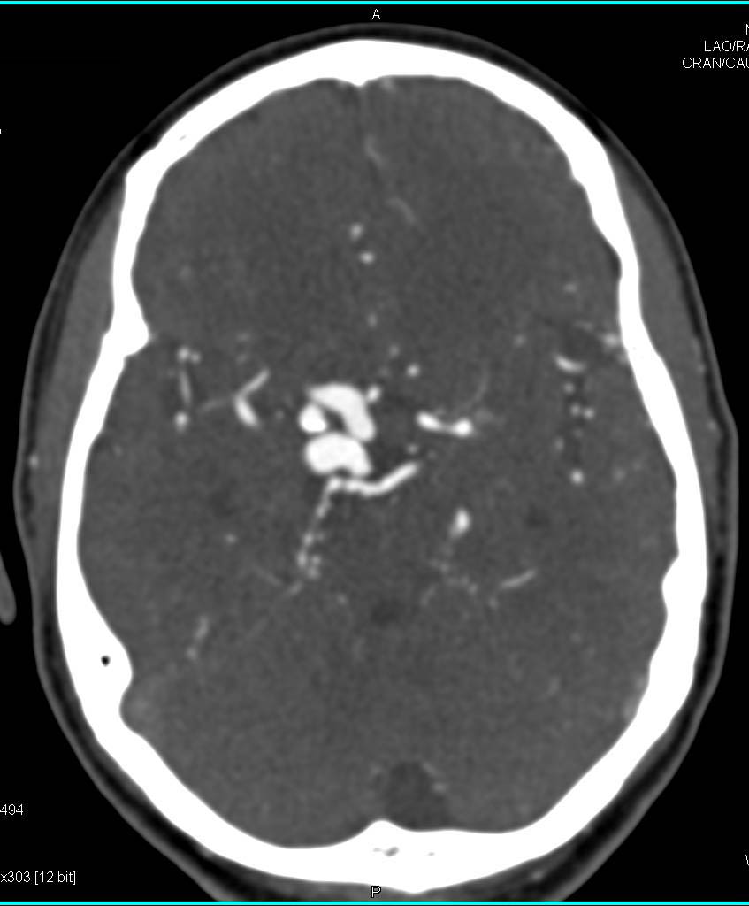 CTA of a Intracranial Aneurysm in 3D - CTisus CT Scan