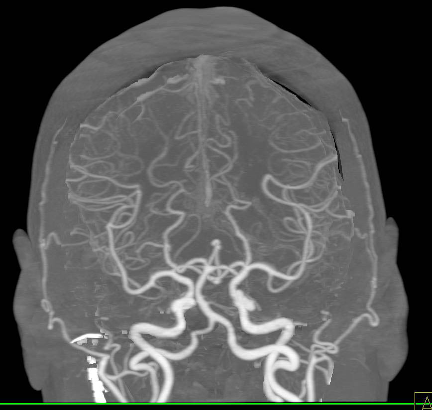 Cta Brain Anatomy