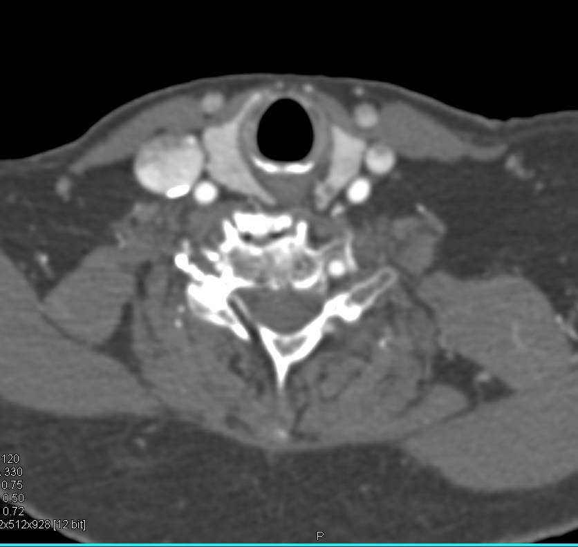 3D Map of Small Thyroid Nodules - CTisus CT Scan