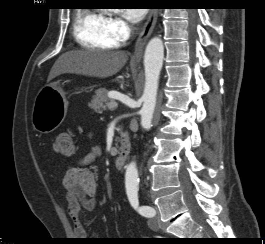 Carotid Circulation in a Patient with Aortic Occlusion. Dual Energy Used for Carotids - CTisus CT Scan