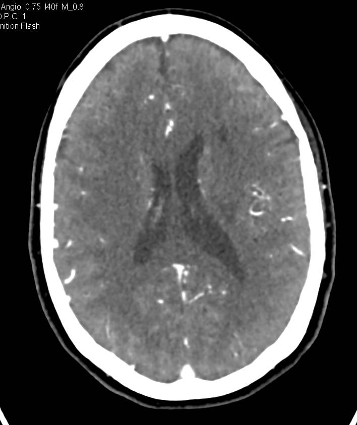 Intracranial CTA with a Nice Look at the Mastoids - CTisus CT Scan