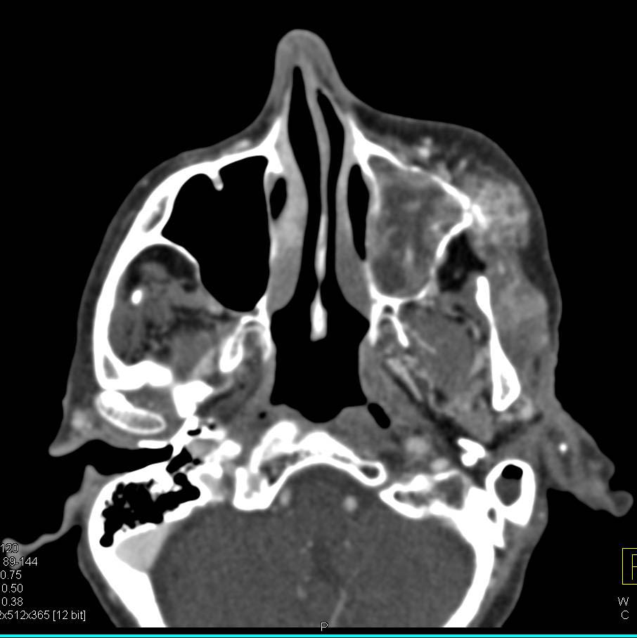 Osteosarcoma of the Orbit with Soft Tissue Mass - CTisus CT Scan