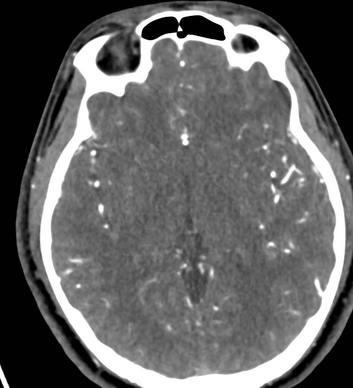 CTA of the Brain - CTisus CT Scan