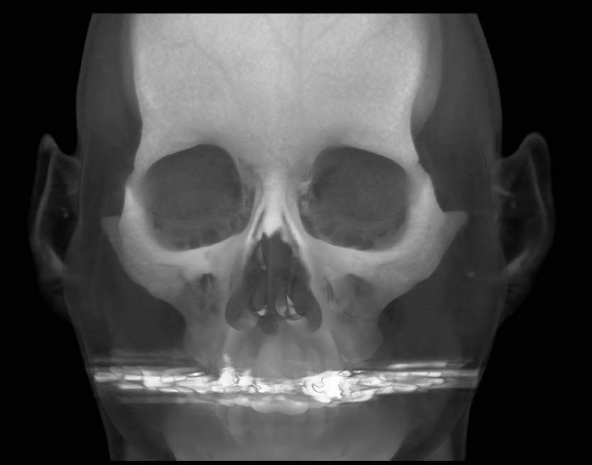 Craniofacial CT with 3D Volume Rendering - CTisus CT Scan