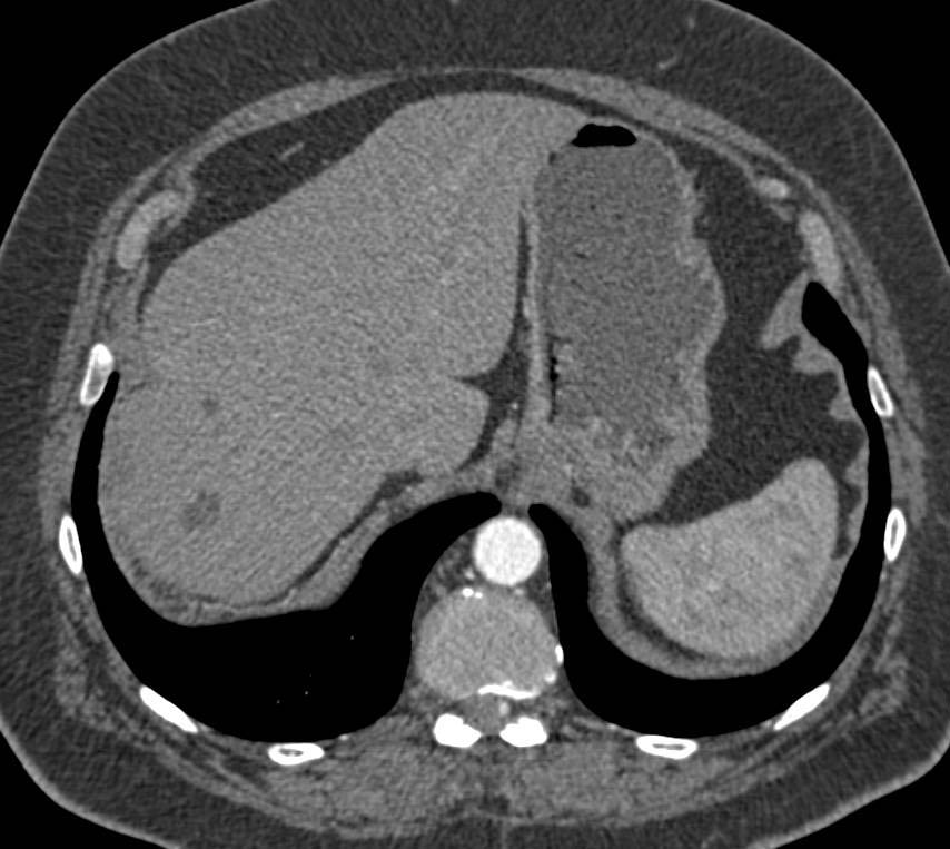 Hemangioblastoma in Spine in Patient with VHL Syndrome (von Hippel Lindau) - CTisus CT Scan