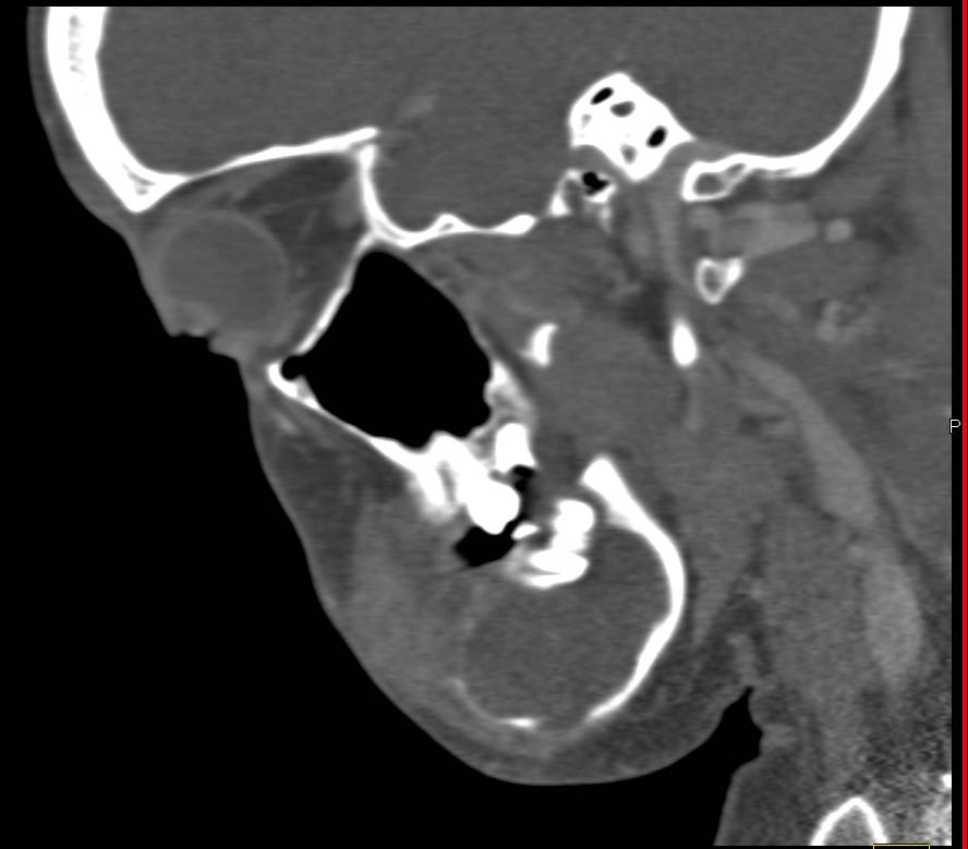 Ameloblastoma of the Mandible - CTisus CT Scan