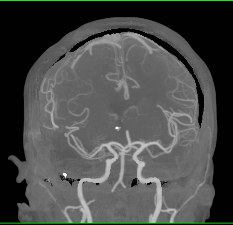 CTA of the Brain with Dual Energy and Bone Removal - CTisus CT Scan