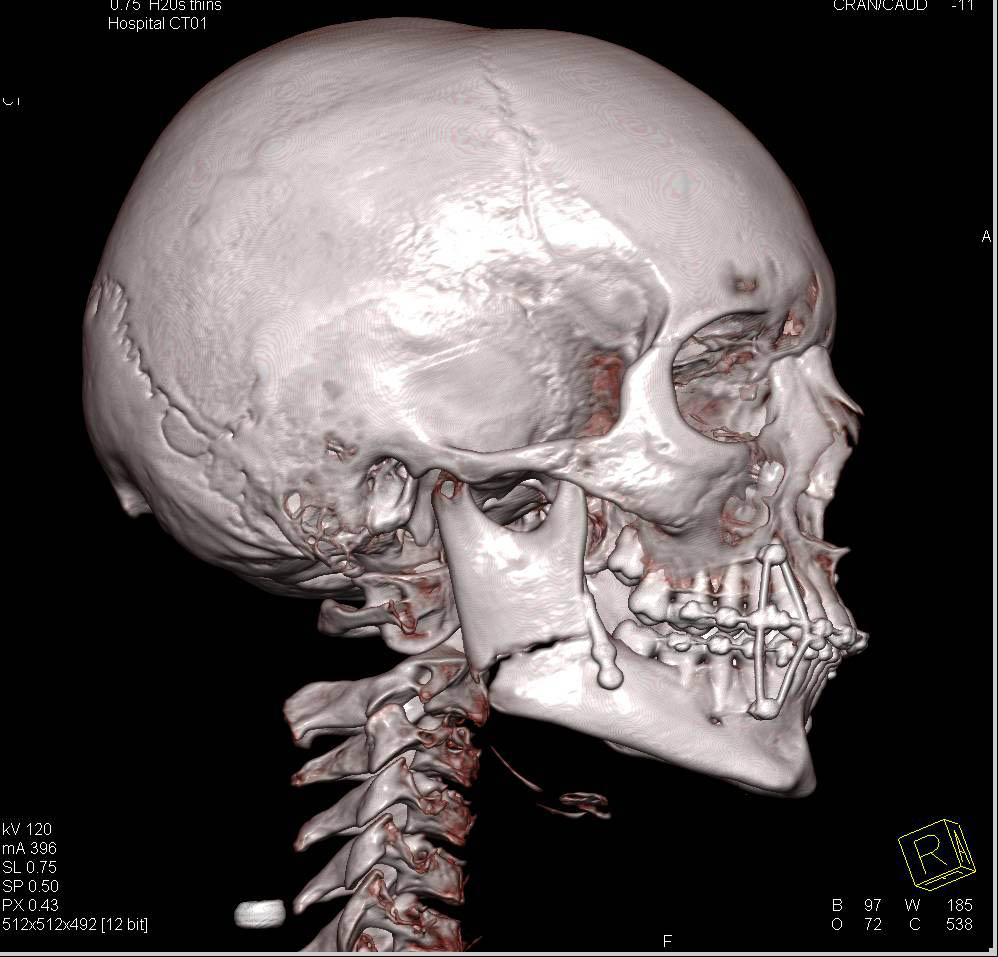 3D VRT of Mandible Fracture with Reduction - CTisus CT Scan