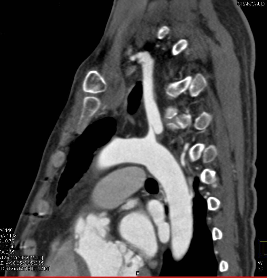 3D Mapping of Left Subclavian Artery Dissection - CTisus CT Scan