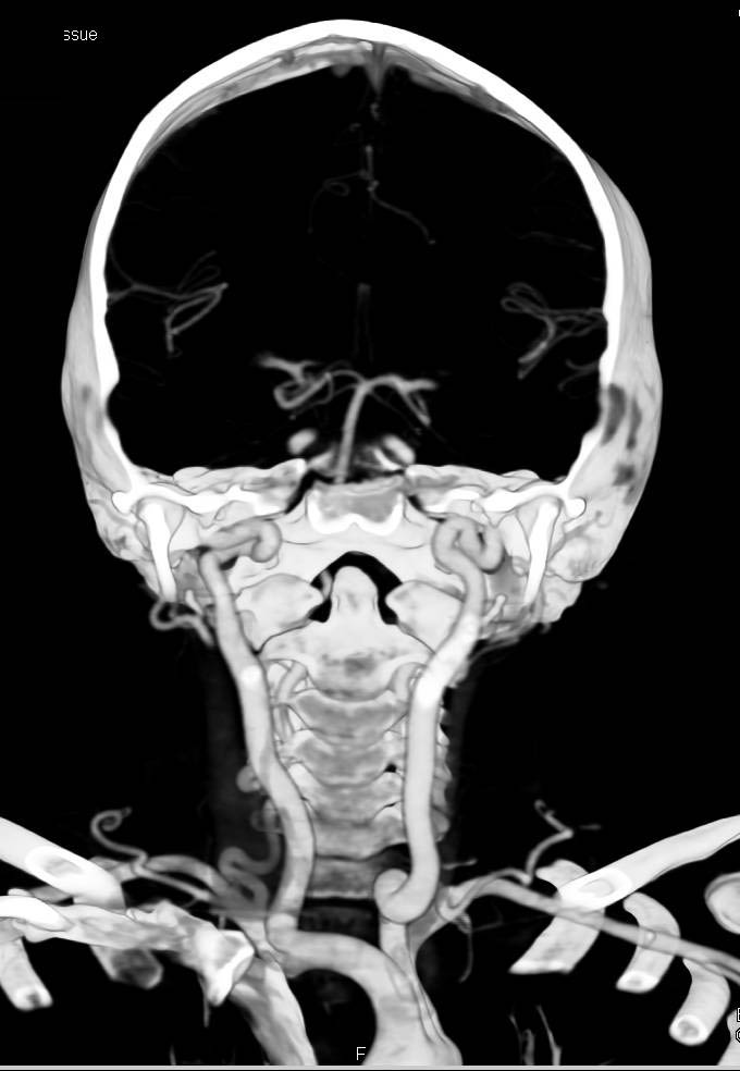 Ectatic Carotid Arteries in Loeys-Dietz Syndrome - CTisus CT Scan