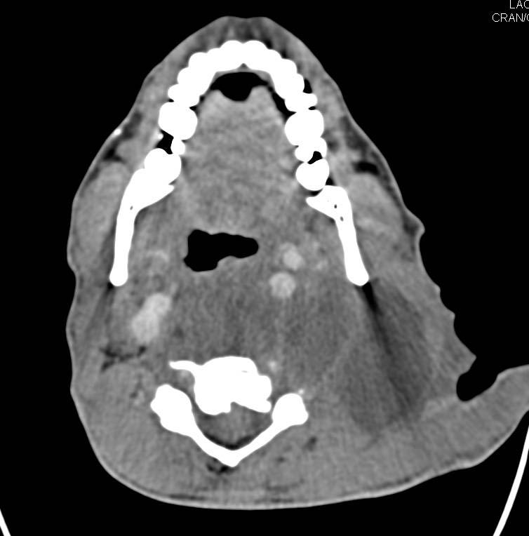 Large Abscess in Hypopharynx - CTisus CT Scan