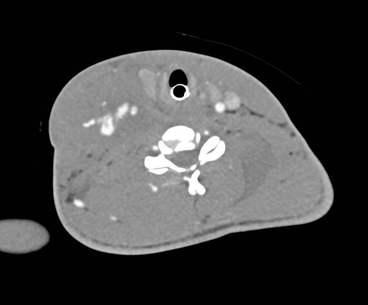 GSW with Injury to Right Carotid Artery with Active Bleeding Seen - CTisus CT Scan