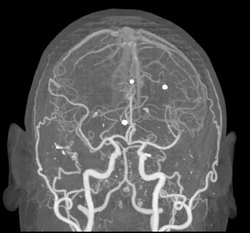 CTA Circle of Willis - CTisus CT Scan