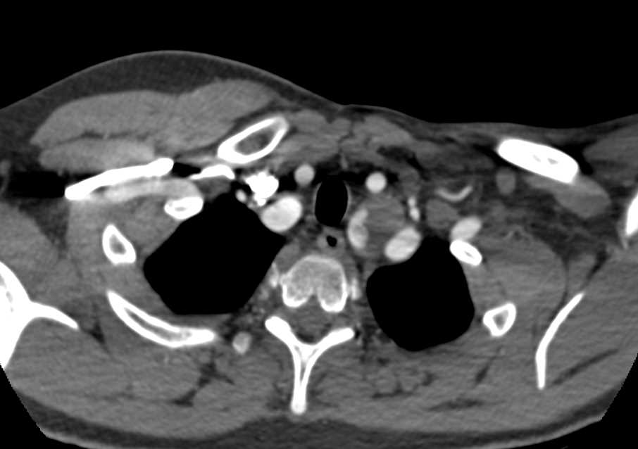 Loeys-Dietz Syndrome with Aneurysms of the Left Subclavian, Left Vertebral and Superior Mesenteric Artery (SMA) Arteries - CTisus CT Scan