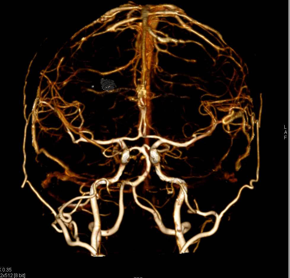 CTA of the Brain with Bone Removal via DE Technique - CTisus CT Scan