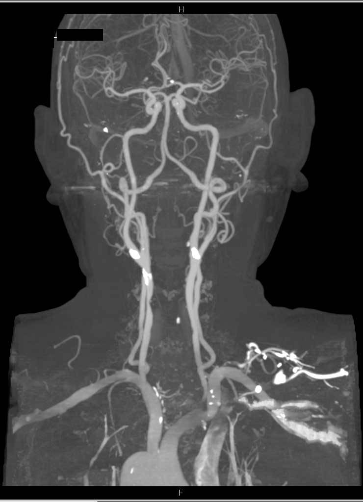 Мрт головы и шеи. Кт ангиография брахиоцефальных сосудов. Ангиография позвоночной артерии. Магнитно-резонансная ангиография артерий шеи. Мрт ангиография артерий шеи.