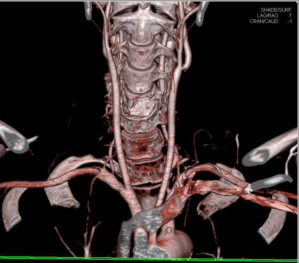 CTA with DE of Carotid Arteries - CTisus CT Scan