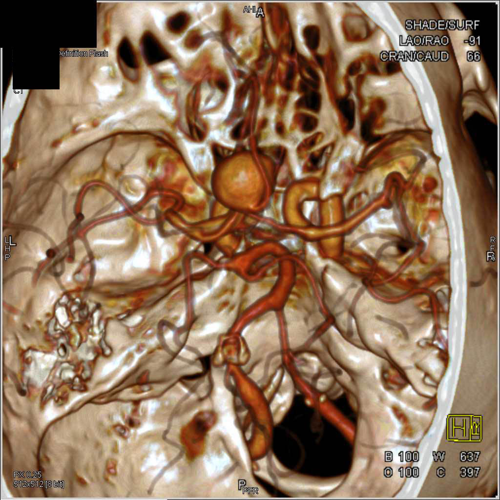 Intracranial Aneurysm in the Circle of Willis - CTisus CT Scan