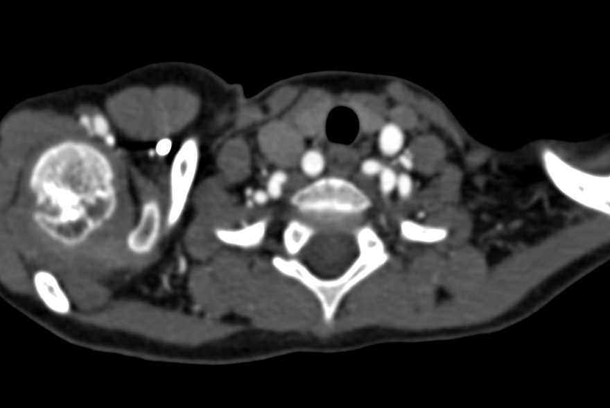 Loeys-Dietz Syndrome with Ectatic Carotid Arteries - CTisus CT Scan