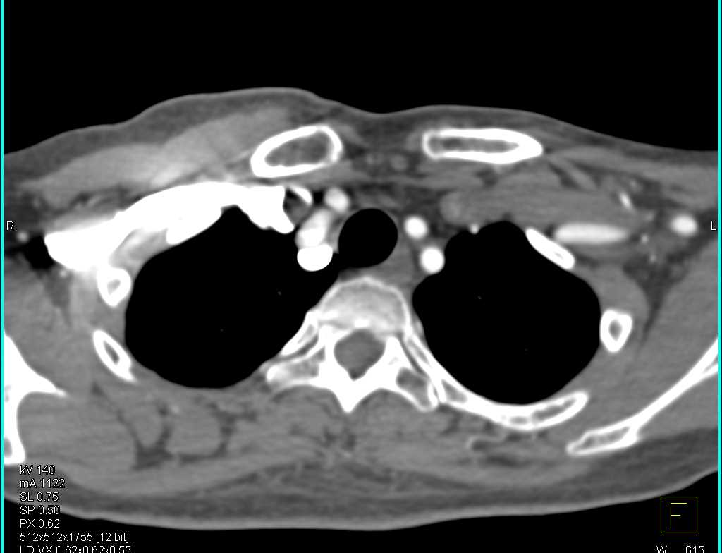 Normal Carotid Arteries - CTisus CT Scan