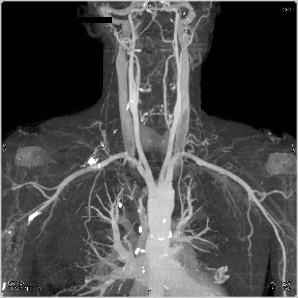 Normal CTA of the Neck - CTisus CT Scan