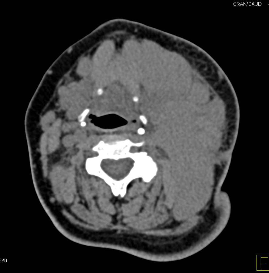 Lymphoma with Massive Neck Adenopathy - CTisus CT Scan