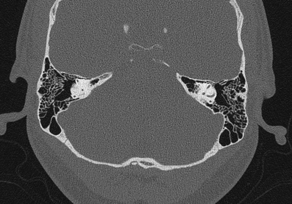 High Resolution CT of the Inner Ear - CTisus CT Scan
